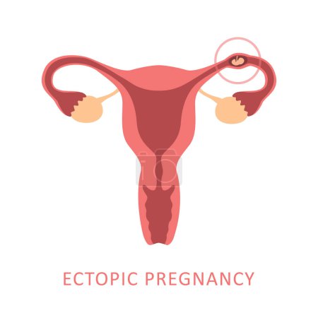 Illustration for Ectopic pregnancy female reproductive system women uterus vector illustration EPS10 - Royalty Free Image