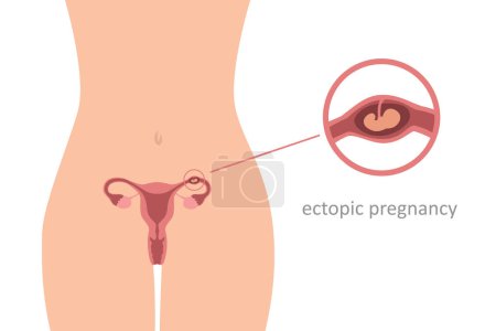 Illustration for Ectopic pregnancy info graphic womens health embryo vector illustration EPS10 - Royalty Free Image