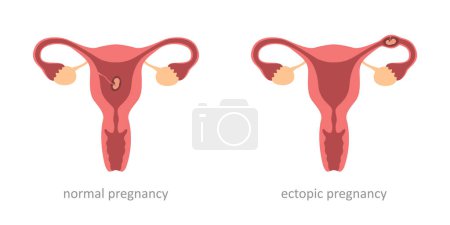 Illustration for Womens health normal and ectopic pregnancy embryo vector illustration EPS10 - Royalty Free Image