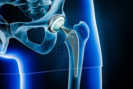 Prothèse ou implant fémoral de la hanche. Chirurgie totale du remplacement des articulations de la hanche ou arthroplastie illustration de rendu 3D. Médecine et santé, arthrite, pathologie, science, ostéologie concepts.