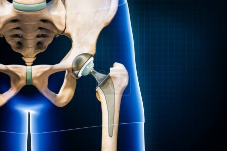 Hüftprothese oder Implantat isoliert auf blauem Hintergrund mit Kopierraum. Hüftgelenk- oder Schenkelkopfersatz 3D-Darstellung. Medizin, Medizin und Gesundheitswesen, Chirurgie, wissenschaftliche Konzepte.