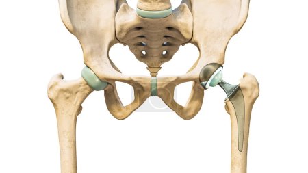 Hüftprothese oder Implantat isoliert auf weißem Hintergrund. Hüftgelenk- oder Schenkelkopfersatz 3D-Darstellung. Medizin, Medizin und Gesundheitswesen, Chirurgie, Wissenschaft, osteologische Konzepte.
