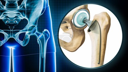 Prothèse fémorale de la hanche ou implant radiographique avec grossissement ou gros plan. Chirurgie totale du remplacement des articulations de la hanche ou arthroplastie illustration de rendu 3D. Médecine et santé, concepts scientifiques.