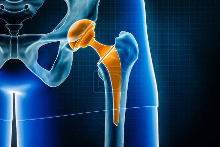 Hip prosthesis x-ray 3D rendering illustration. Total hip joint replacement surgery or arthroplasty, medical and healthcare, arthritis, pathology, science, osteology, orthopedics concepts.