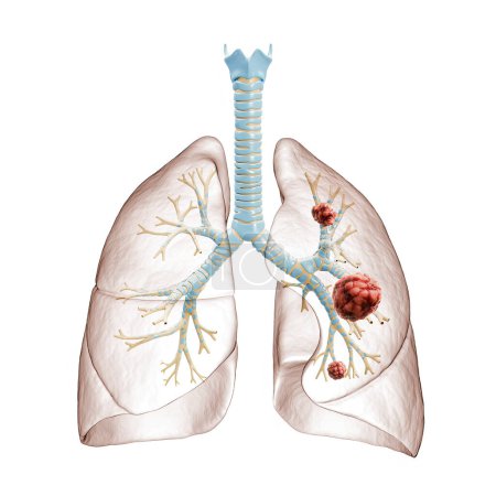 Cáncer de pulmón o carcinoma Ilustración de la representación 3D. Árbol bronquial y pulmones infectados por células cancerosas sobre fondo blanco. Médico, salud, oncología, enfermedad, concepto de ciencia.