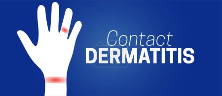 Ilustración de Contacto Dermatitis Antecedentes Ilustración con la mano con irritaciones - Imagen libre de derechos