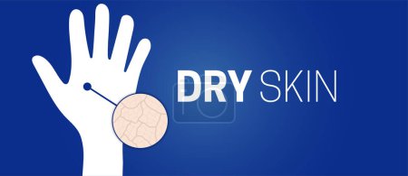 Illustration for Dry Skin on Hand Background Illustration Design - Royalty Free Image