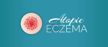 Illustration for Atopic Eczema Background Illustration Banner - Royalty Free Image