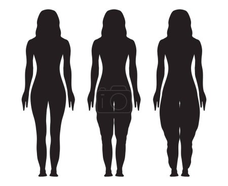 Illustration for Lipedema Silhouette Illustration with Woman with Normal and Lipedema Stages - Royalty Free Image