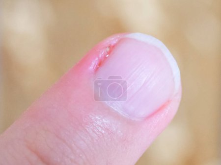 A close-up of a human finger showing a healing cut.