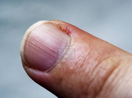 A human finger with evident signs of minor injury.