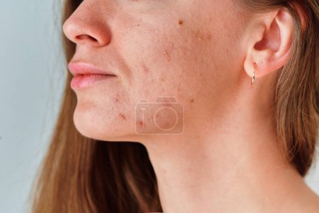 Young woman suffering from problem skin and acne closeup