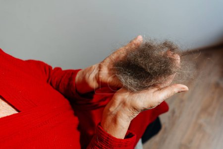 Téléchargez les photos : Une femme chauve de chimiothérapie. La perte de cheveux de ma grand-mère est due à une tumeur cancéreuse. une touffe de cheveux dans les mains d'une femme atteinte de la maladie - en image libre de droit