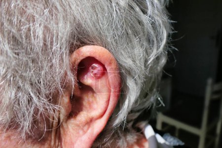 Téléchargez les photos : Carcinome basocellulaire sur une oreille due à une surexposition aux UVA en particulier la lumière du soleil, ce qui nécessite une opération pour l'enlever - en image libre de droit