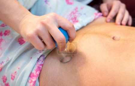 Foto de La doula posparto muestra cómo masajear una cicatriz de cesárea con un frasco de vacío. Procedimientos de recuperación después del parto. - Imagen libre de derechos