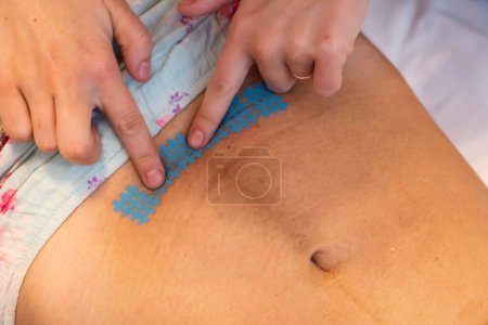 Foto de Una doula grabando una cicatriz de cesárea con cinta de kinesiología. Recuperación después del parto. - Imagen libre de derechos