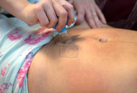Foto de La doula posparto muestra cómo masajear una cicatriz de cesárea con un frasco de vacío. Procedimientos de recuperación después del parto. - Imagen libre de derechos