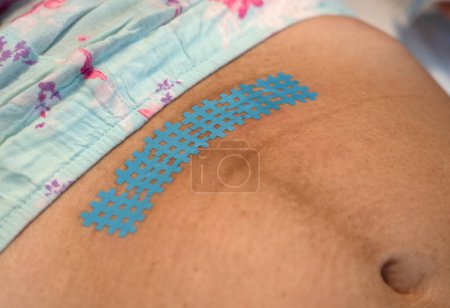 Foto de Colocar una cinta de cinesiología en una cicatriz después de una cesárea. Recuperación después del parto. - Imagen libre de derechos