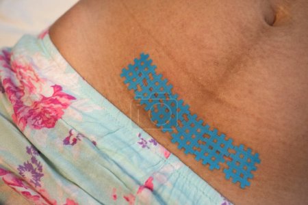 Photo for Taping a kinesiology tape on a scar after a caesarean section. Recovery after childbirth. - Royalty Free Image
