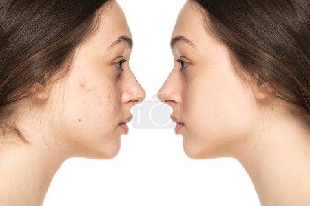 Photo for Cropped shot of a young woman's face before and after acne treatment. Pimples, red scars on the girl's cheeks. Problem skin, care and beauty concept. - Royalty Free Image