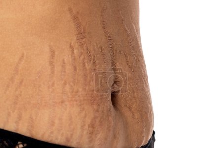 Photo for Female belly with stretch marks closeup - Royalty Free Image