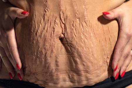Téléchargez les photos : Femme affichant une peau lâche et des vergetures sur son ventre après la grossesse - en image libre de droit