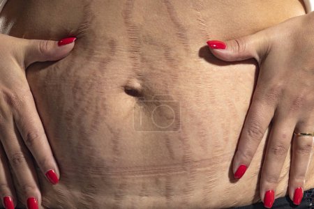 Photo for Woman displaying loose skin and stretch marks on her belly after pregnancy - Royalty Free Image