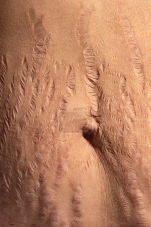 Photo for Close up human Skin natural stretch marks Texture background. Stretch mark woman belly. - Royalty Free Image