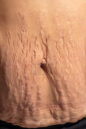 Close up human Skin natural stretch marks Texture background. Stretch mark woman belly.
