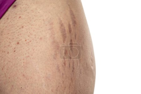 Téléchargez les photos : Hanche féminine avec vergetures et aine avec points peau sensible à l'acné problématique sur fond blanc - en image libre de droit