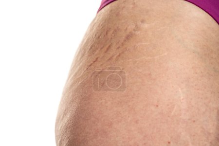 Téléchargez les photos : Hanche féminine avec vergetures peau sensible problématique sur fond blanc - en image libre de droit