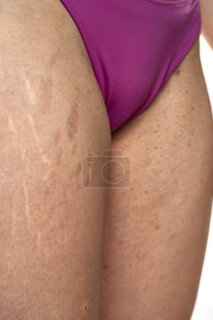 Téléchargez les photos : Hanche féminine avec vergetures et aine avec points peau sensible à l'acné problématique. - en image libre de droit