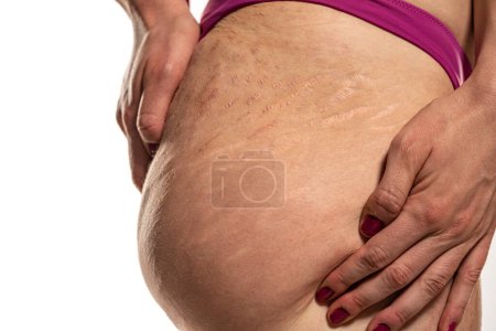 Photo for Close-up of a female thigh with white and dark stretch marks from a sharp weight loss or weight gain isolated on a white studio background - Royalty Free Image