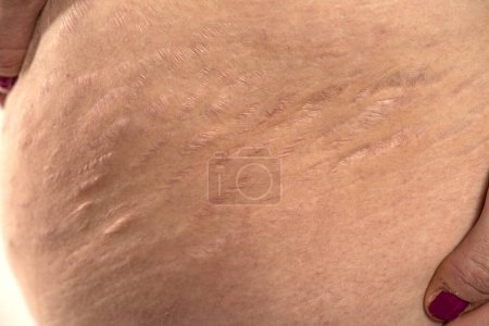 Photo for Close-up of a female thigh with white and dark stretch marks from a sharp weight loss or weight gain isolated on a white studio background - Royalty Free Image