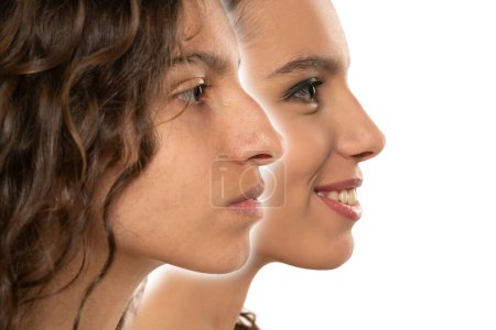 Foto de Rinoplastia femenina. Mujer Forma de la nariz antes y después de la cirugía plástica. Perfil de la mujer Vista lateral sobre fondo aislado White Studio - Imagen libre de derechos