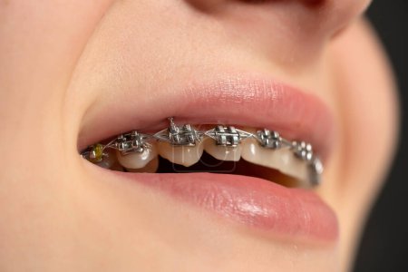 Foto de Hermoso macroplano de dientes blancos naturales con aparatos ortopédicos. Foto de cuidado dental. Mujer belleza sonrisa con accesorios de ortodoncia. Primer plano de la boca femenina saludable - Imagen libre de derechos