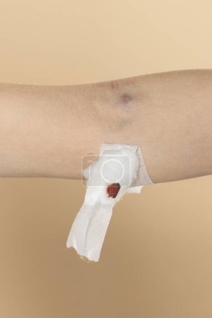 Photo for Woman patient show cotton wool stop bleeding, after blood drawing testing for annually physical health check up to check cholesterol, blood pressure, and sugar level - Royalty Free Image