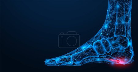 Espuela del talón, lesión del ligamento plantar de la pierna. Diseño poligonal de líneas y puntos interconectados. Fondo azul.