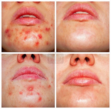 Photo with and without acne. Problem skin and beauty concept. Photos before and after treatment.