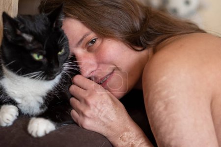 Foto de Adult woman lying in bed with her cat with wounds from self harm on her naked shoulder - Imagen libre de derechos