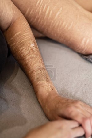 brazo y pierna de una mujer con fuertes cortes y cicatrices de la auto-mutilación en la frustración, auto-abuso, trastorno límite de la personalidad