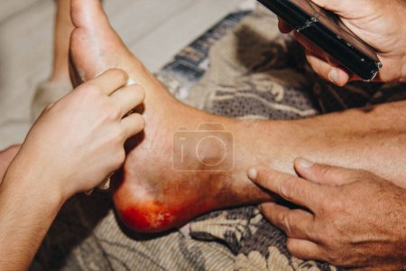 Foto de The process of treating a leg injury at home. Scar after surgery. Bone replacement. Titanium foot - Imagen libre de derechos