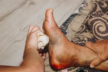 Foto de The process of treating a leg injury at home. Scar after surgery. Bone replacement. Titanium foot - Imagen libre de derechos