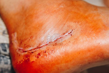 Foto de A scar on the leg after a foot replacement operation. Broken leg bone. Close up. Pain, trauma, wound treatment - Imagen libre de derechos
