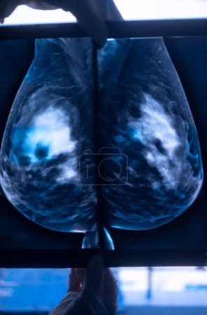 Téléchargez les photos : Mamogramme mammaire image de résultat de balayage de test de rayons X pour des seins sains cancer libre. - en image libre de droit