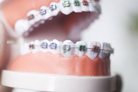 Téléchargez les photos : Support d'alignement de dents dentaires enseignant le modèle étudiant montrant les gencives et les redresseurs de dents métalliques. - en image libre de droit