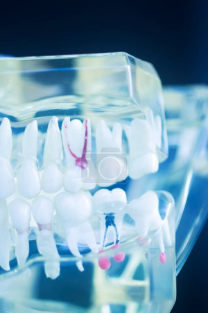 Téléchargez les photos : Modèle de carie dentaire montrant des caries dans la dent - en image libre de droit