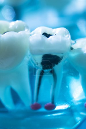 Téléchargez les photos : Carie dentaire allant au canal radiculaire dans les dents enseignant le modèle médical. - en image libre de droit