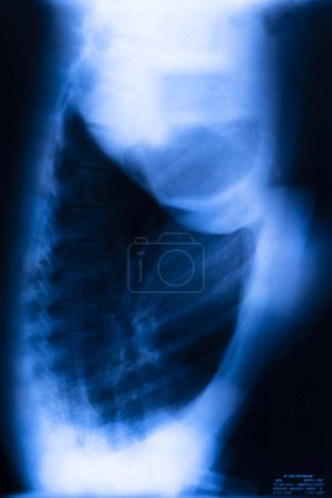 Téléchargez les photos : Résultats du test de radiographie des côtes pulmonaires. - en image libre de droit