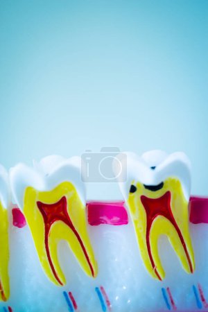 Téléchargez les photos : Modèle dentaire montrant la carie dentaire, les gencives et le canal radiculaire. - en image libre de droit
